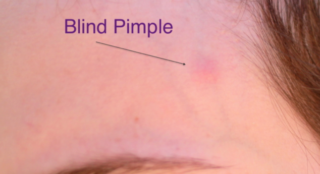 How to get rid of blind pimples