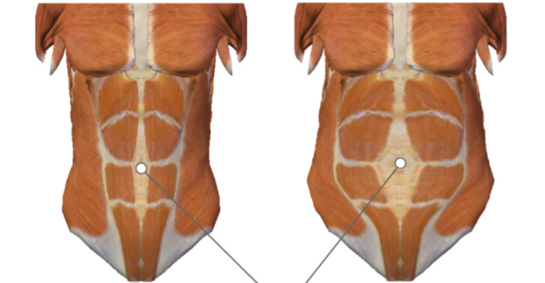 Диастаз прямых мышц живота код. Диастаз прямой мышцы живота у мужчин. Конфигурация живота. Черепно-челюстной диастаз. Диастаз под левым куполом диафрагмы.