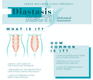 How to Heal Diastasis Recti Without Surgery - Mom Generations | Stylish ...